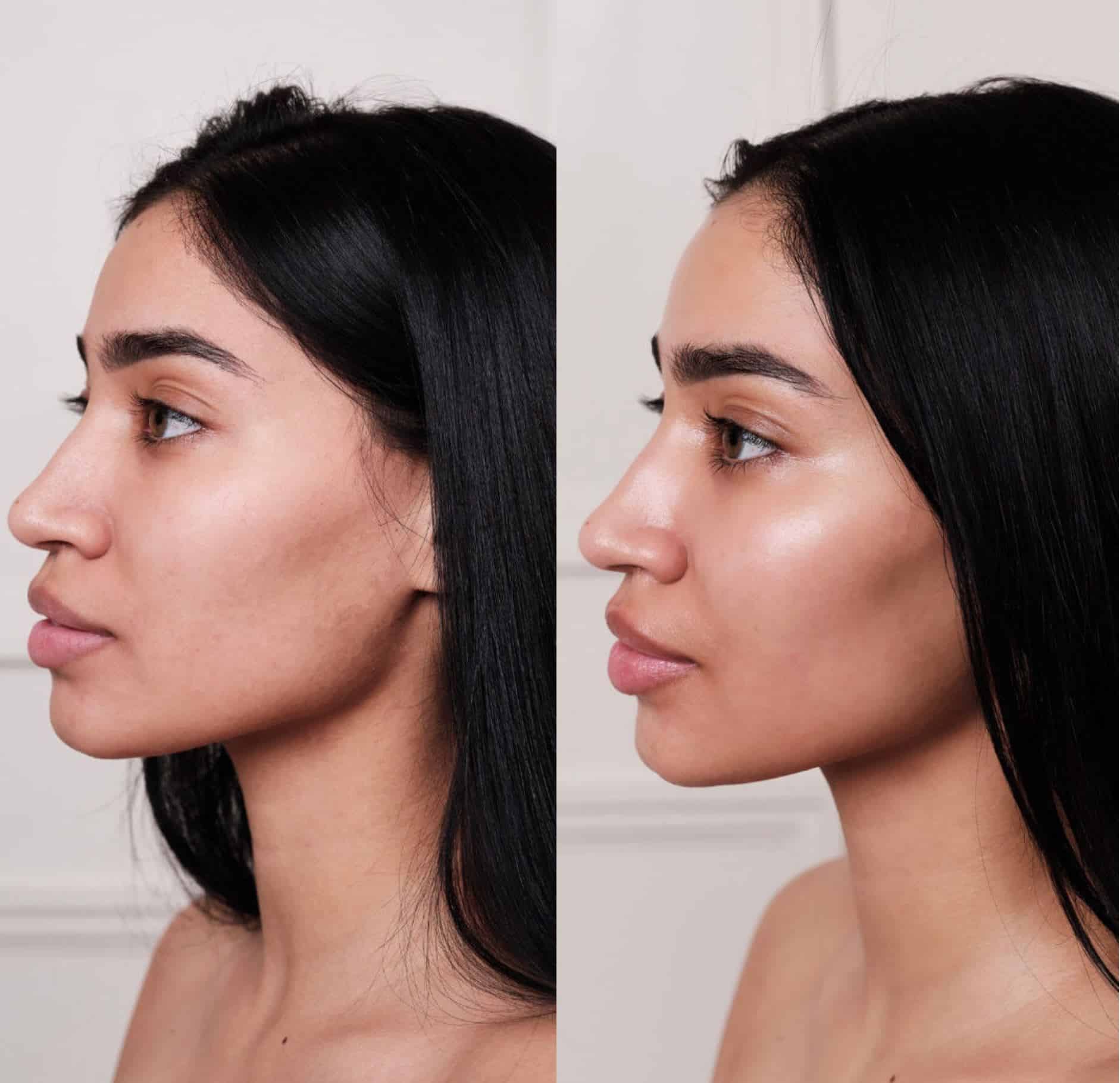 Profile showing clearer, more light-reflective skin after Hydrafacial in McLean VA
