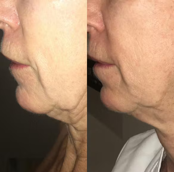 Microneedling - results 1