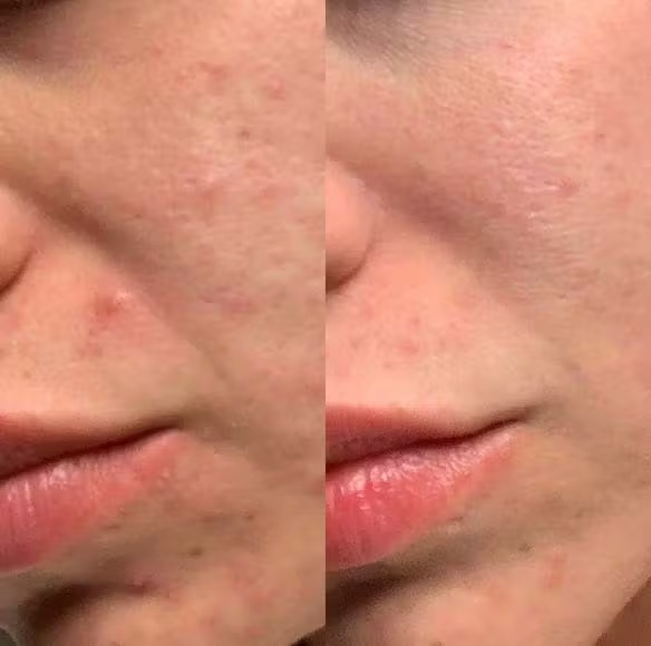 Microneedling - results 2