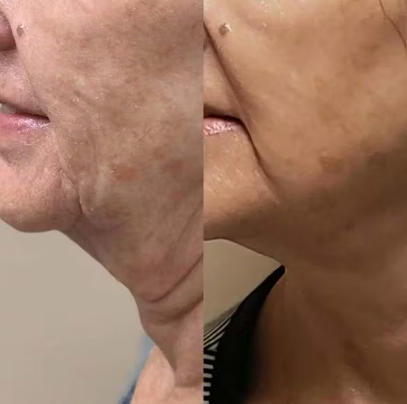 Microneedling - results 3