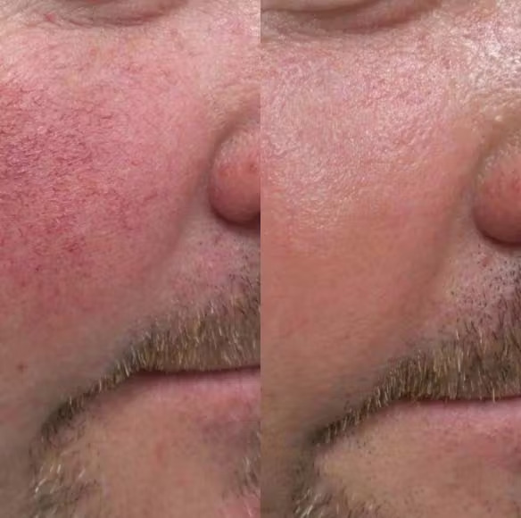 IPL Photofacial - Results 1