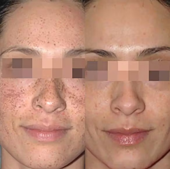 IPL Photofacial - Results 2