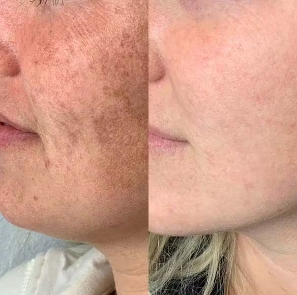 IPL Photofacial - Results 3