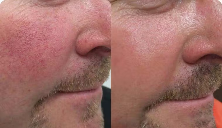 IPL Photofacial - results