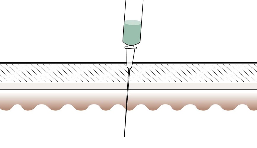 Dermal Fillers - how it works - Step 2