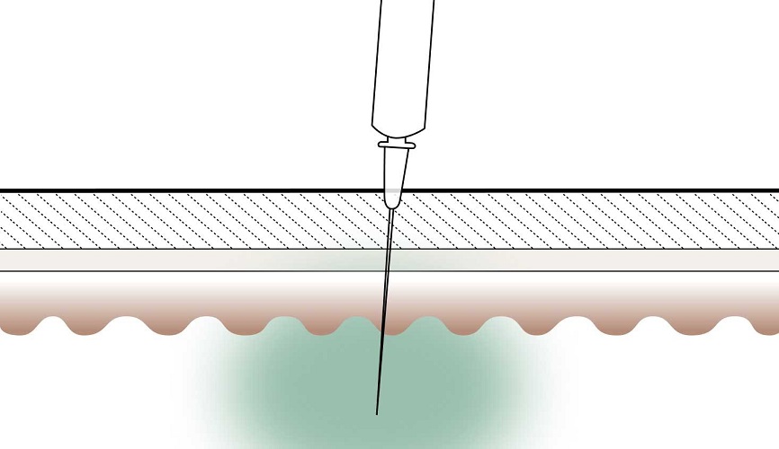 Dermal Fillers - how it works - Step 3