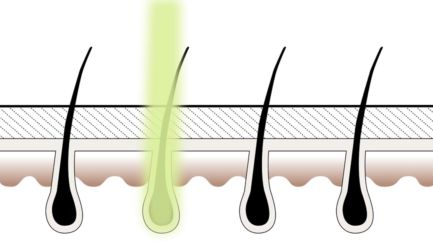 Step 1: Laser Treatment