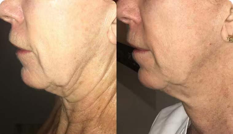 Microneedling - results