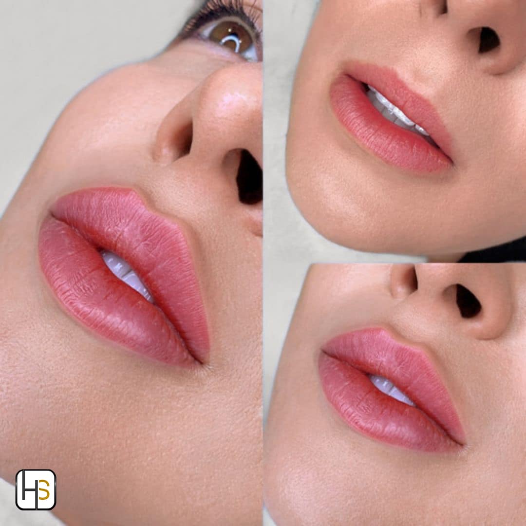 Lip filler in Falls Church VA result showing increased lip volume and border definition from two angles