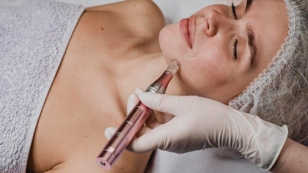 How Long Does Microneedling Last?