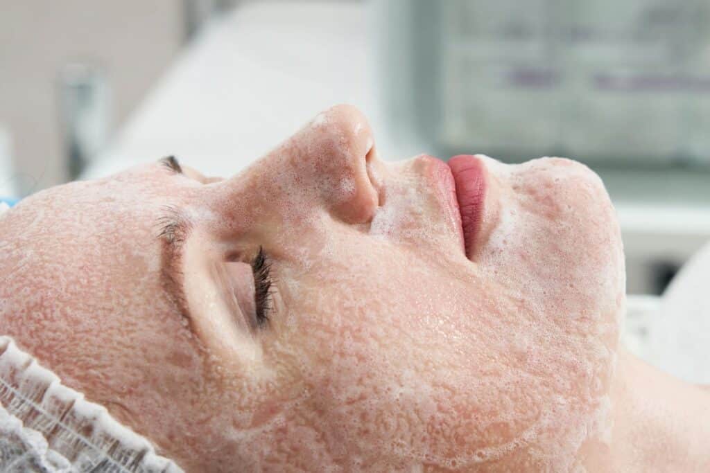 Microneedling vs Chemical Peels