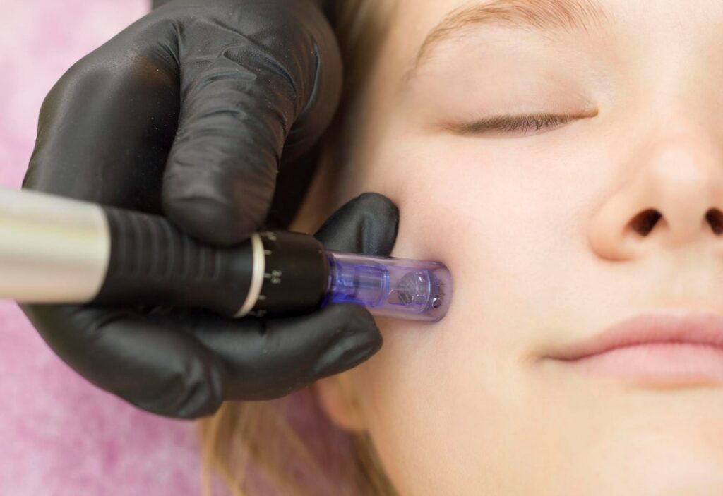 Microneedling vs Chemical Peels
