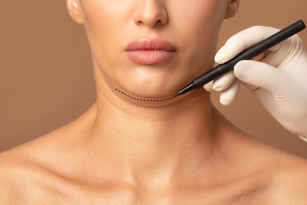 Is Kybella Permanent?