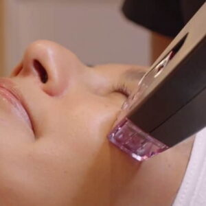 Acne scar treatment with microneedling at HS MedSpa in Tysons, VA