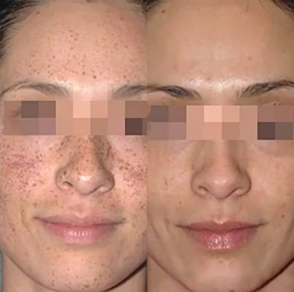 Freckling and sun spots lighter after an IPL photofacial in Merrifield VA