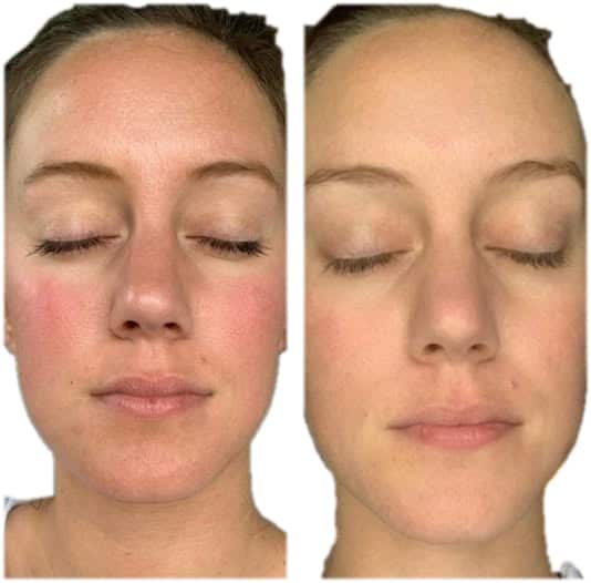IPL photofacial before and after, front view, showing less redness across the cheeks and nose. Individual results vary.