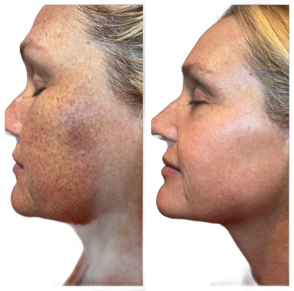 IPL photofacial before and after, profile view, showing lighter freckling and sun spots on the cheek. Individual results vary.